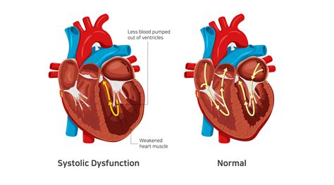 lv systolic dysfunction treatment.